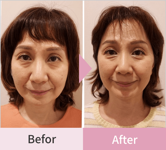 Before After1