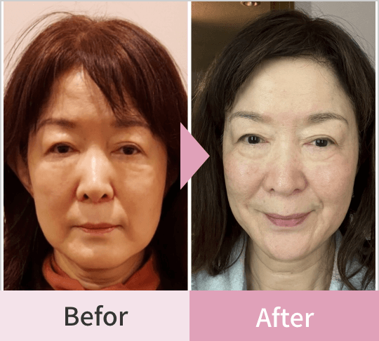 Before After2